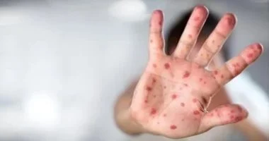 جدري